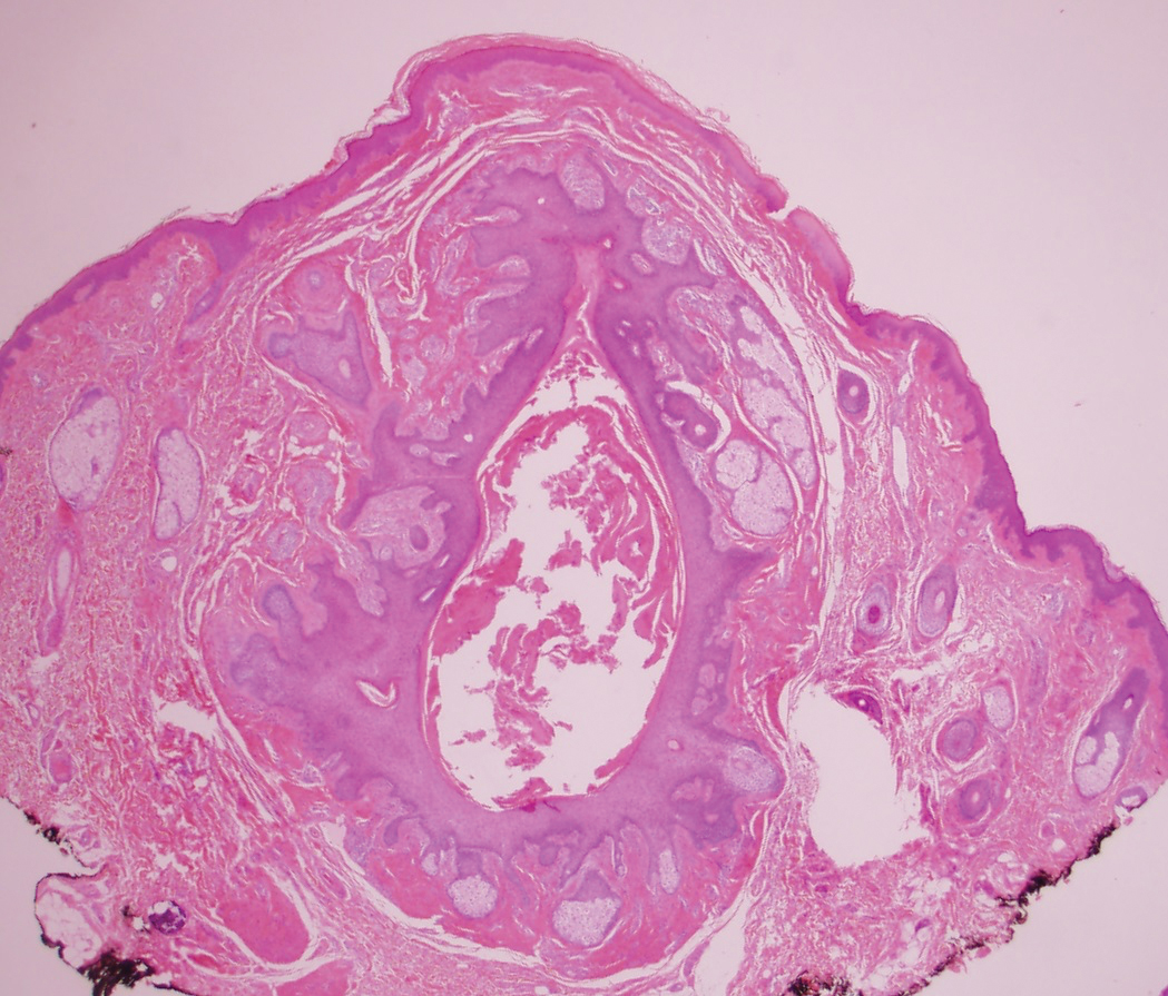 Subcutaneous Nodule On The Chest Mdedge Dermatology